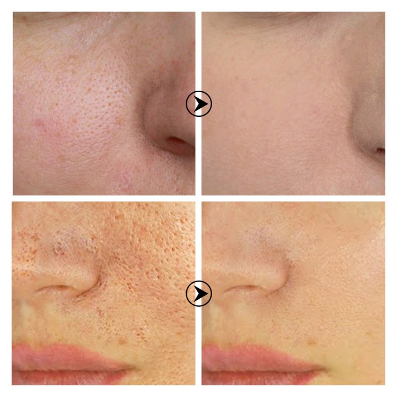 Tea Tree Pore Shrinking Serum - Image 5