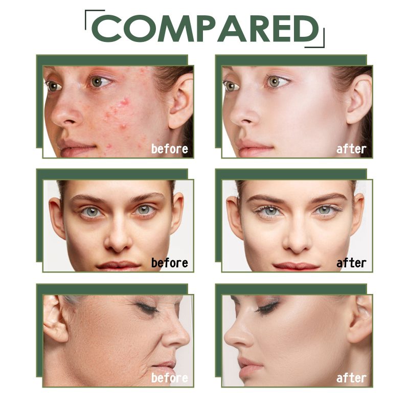 Acne Marks Blackhead Brightening Skin Serum - Image 8