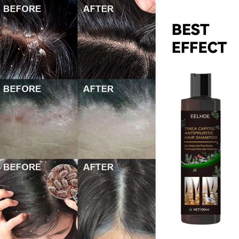 Anti-Dandruff Shampoo For Scalp Itching - Image 3